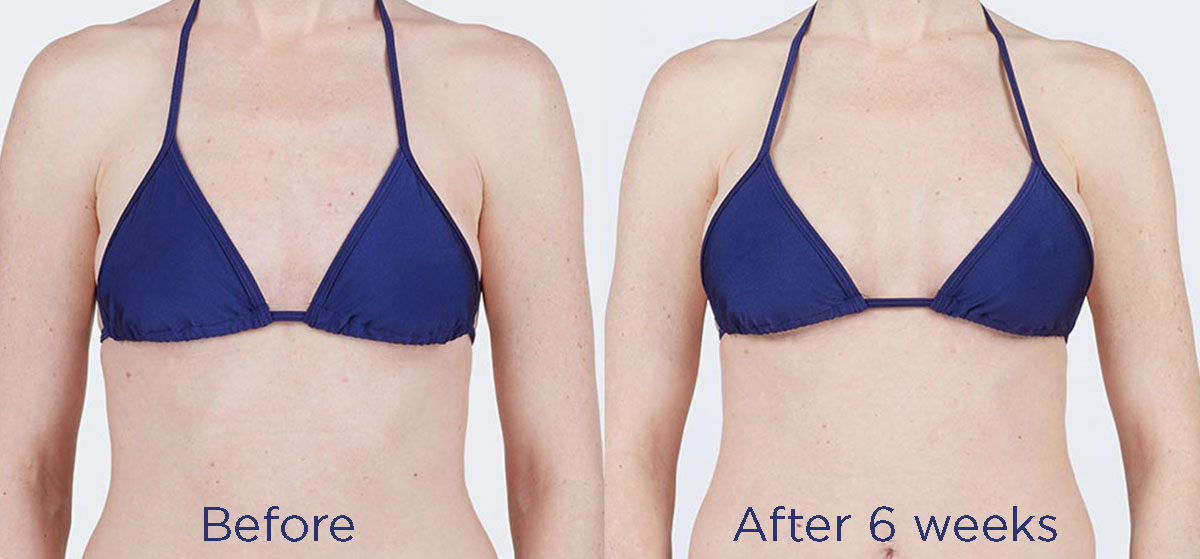 Breast procedure before and after